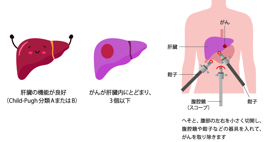 肝細胞がんの治療の種類｜PLUS CHUGAI 中外製薬医療関係者向けサイト