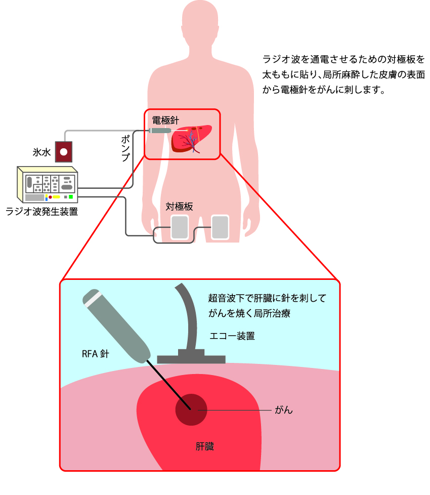肝癌のラジオ波焼灼療法/医学書院/沖田極（単行本） ラジオ波焼灼療法: 安全で効果的な肝癌治療テクニック | 小俣
