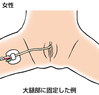 手技手順 Plus Chugai 中外製薬医療関係者向けサイト 医師向け