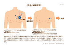 術前療法| HER2陽性乳がんインフォームドコンセントツール