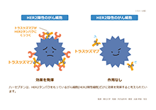 術前療法| HER2陽性乳がんインフォームドコンセントツール